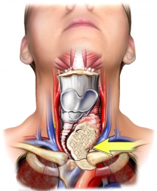 cancer thyroide